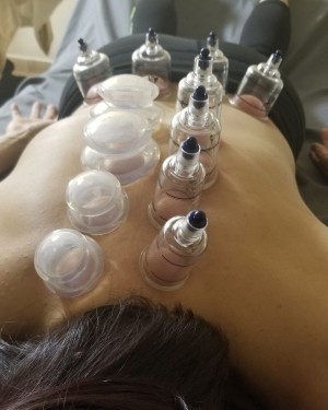 Cupping Technique