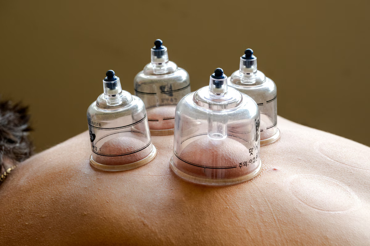 Close-up of cupping therapy massage cups used for muscle recovery, pain relief, and therapeutic bodywork treatment.